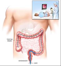 вздутие живота после колоноскопии